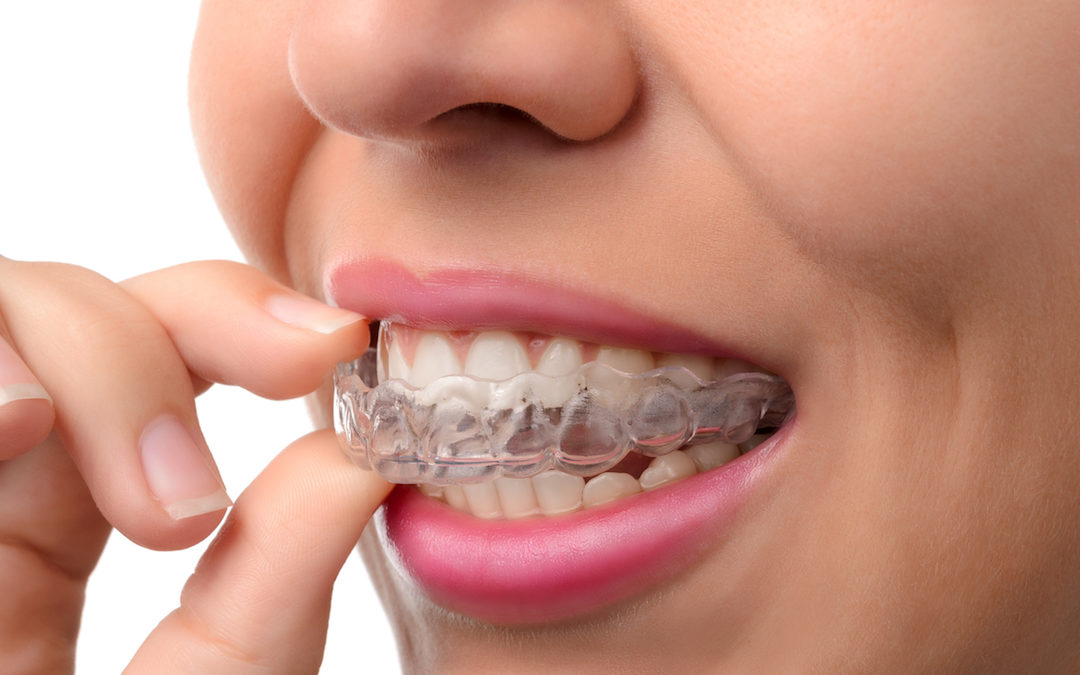 Lisp? Jaw Pain? Maybe it’s time to consider Invisalign